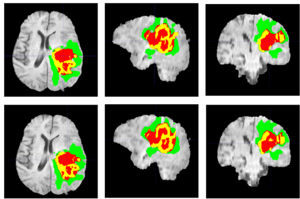 شناسایی تومور با پردازش تصویر